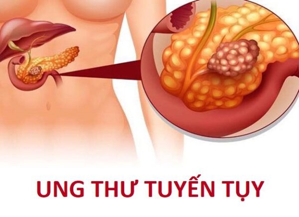 bệnh nhân mắc bệnh ung thư tuyến tụy