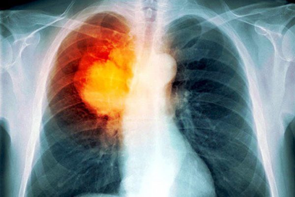 Bệnh lao phổi có nguy hiểm không?