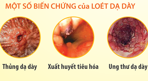 Viêm loét dạ dày lâu ngày không được điều trị triệt để có thể gây biến chứng ung thư
