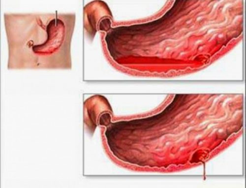 Xuất huyết tiêu hóa là một cấp cứu nội, ngoại khoa thường gặp có thể gây nguy hiểm đến tính mạng của người bệnh nếu không được phát hiện sớm và cấp cứu kịp thời.