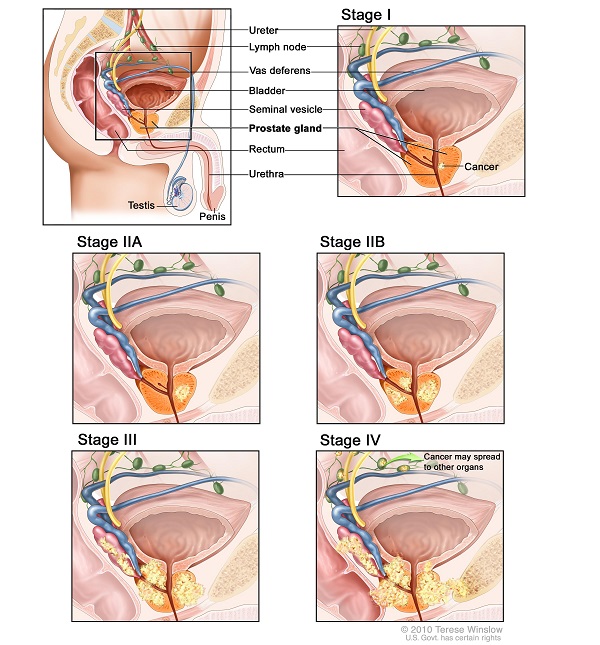 Các giai đoạn ung thư tuyến tiền liệt