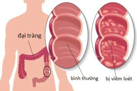 Các bệnh lý về đường tiêu hóa có thể gây đầy hơi, chướng bụng