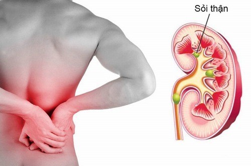Uống nước có thể giúp phòng ngừa bệnh sỏi thận