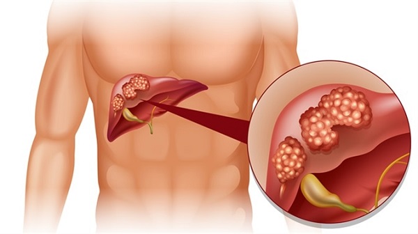 Điều trị ung thư gan như thế nào phụ thuộc vào nhiều yếu tố