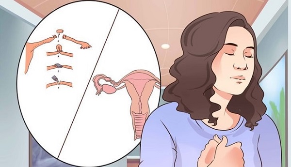 Nguyên nhân tắc vòi trứng chủ yếu là do nhiễm khuẩn âm đạo, cổ tử cung