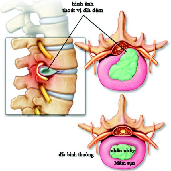 Thoát vị đĩa đệm là tình trạng nhân nhầy đĩa đệm ở giữa các đốt sống thoát ra khỏi những thớ sợi bao quanh bên ngoài.