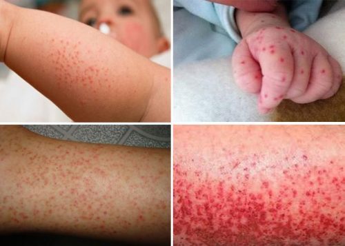 Sốt xuất huyết dễ mắc mùa nào là băn khoăn, thắc mắc của rất nhiều người.
