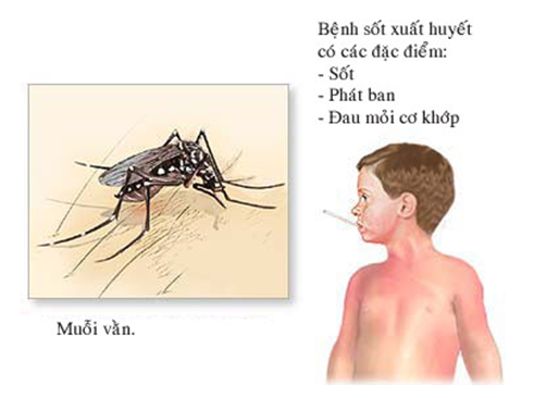 Sốt xuất huyết là bệnh truyền nhiễm cấp tính do siêu vi trùng Dengue gây ra.