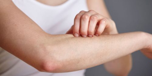 Bị sốt xuất huyết quan hệ có sao không là băn khoăn, thắc mắc của rất nhiều người đặc biệt là những bệnh nhân sốt xuất huyết.