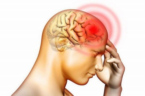 Thoát vị đĩa đệm cột sống cổ có thể gây tình trạng đau đầu, thiếu máu lên não 