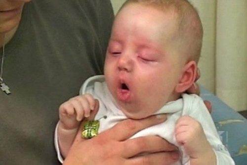 Trẻ nôn ra máu là một triệu chứng của xuất huyết tiêu hóa ở trẻ