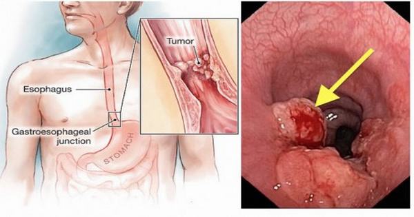 U thực quản lành tính được chia thành nhiều loại u khác nhau