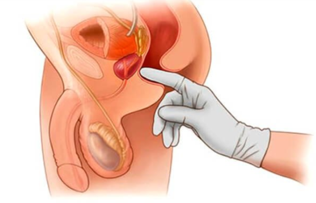 Hình ảnh minh hoạ khám tiền liệt tuyến thông qua trực tràng