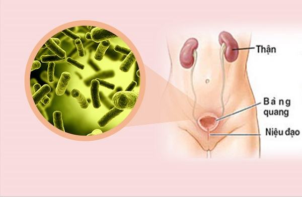 Viêm bàng quang thường gặp ở nữ