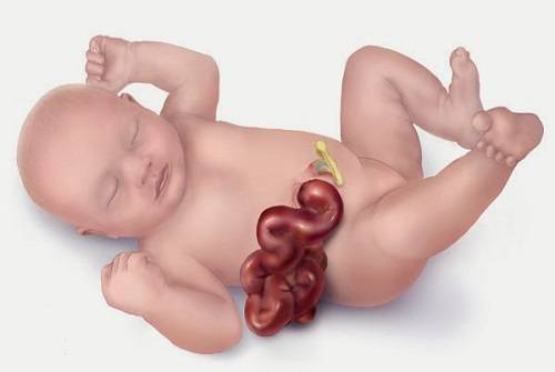 Xoắn ruột ở trẻ sơ sinh xảy ra khi một phần ruột non hoặc ruột già bị xoắn lại
