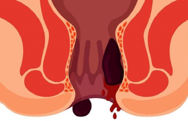 Chảy máu hậu môn là bệnh gì? - Bệnh trĩ