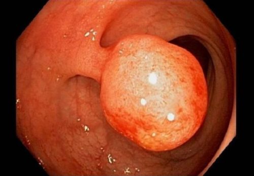 Để biết thêm thông tin chi tiết về bệnh polyp trực tràng và đặt hẹn khám các bệnh đường tiêu hóa tại Bệnh viện Thu Cúc, vui lòng liên hệ 1900 558892 hoặc hotline 090497090 để được tư vấn và hỗ trợ.
