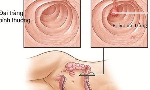 Hình ảnh đại trực tràng bình thường và đại trực tràng bị polyp