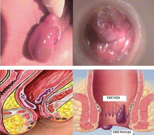 Hậu môn trực tràng sa xuống là một trong những bệnh khá phổ biến ở hậu môn gây ảnh hưởng không nhỏ đến cuộc sống sinh hoạt và sức khỏe của người bệnh.