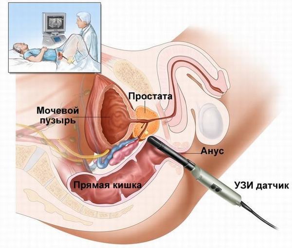 Người bệnh cần đi khám và thực hiện siêu âm tuyến tiền liệt qua đầu dò trực tràng để phát hiện bệnh