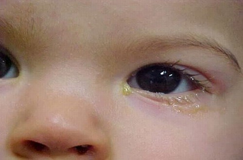 Mắt đổ ghèn có thể là triệu chứng cảnh báo mắt bé bị tổn thương