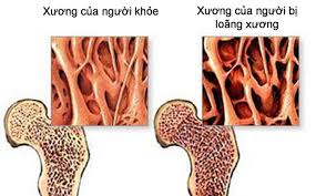 Loãng xương đang ngày càng gia tăng trong cộng động