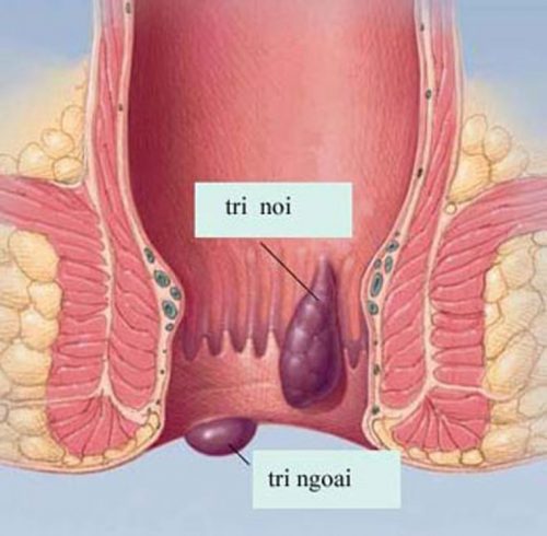Ngứa hậu môn có thể là triệu chứng của bệnh trĩ