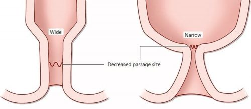 40% người bệnh sau mỗ trĩ phải đối mặt với chứng hẹp hậu môn
