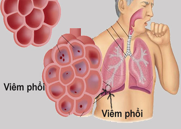 NSE có liên quan đến nhiều bệnh lý lành tính khác như viêm phổi