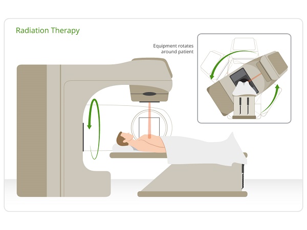 Xạ trị là một trong những phương pháp điều trị ung thư phổi quan trọng