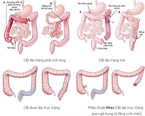 Phẫu thuật cắt trực tràng bằng phương pháp nội soi ít xâm lấn được áp dụng ngày càng nhiều.