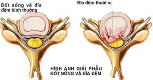 Thoát vị đĩa đệm cần được phát hiện sớm và điều trị hiệu quả