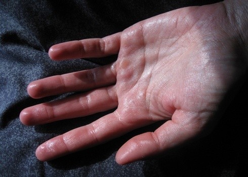 Thường xuyên bị ra mồ hôi toàn thân, đặc biệt ở vùng lòng bàn chân, bàn tay là một biểu hiện của chứng rối loạn thần kinh thực vật