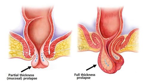 Sa trực tràng có 2 loại là: sa trực tràng toàn phần và sa trực tràng một phần