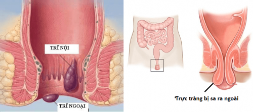 Sa trực tràng thường được sử dụng đồng nghĩa với bệnh sa trực tràng hoàn toàn hay còn gọi là sa trực tràng ra bên ngoài