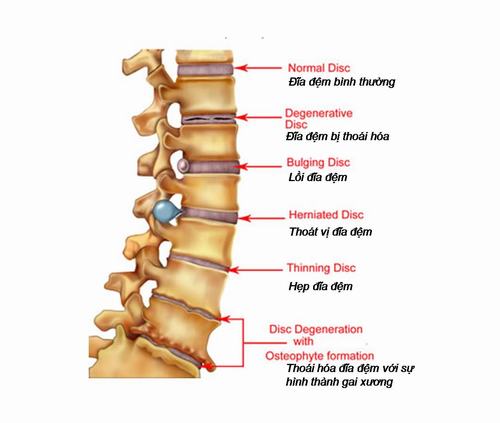 Phồng đĩa đệm đa tầng có thể tiến triển thành thoát vị