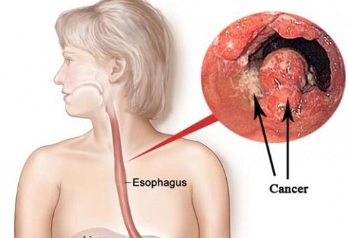 Ung thư thực quản là một trong những bệnh lý ung thư nguy hiểm trong các bệnh ung thư đường tiêu hóa.