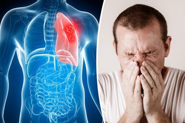 Triệu chứng u phổi lành tính
