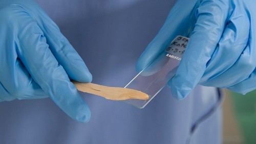 Pap test phát hiện những bất thường sớm ở cổ tử cung