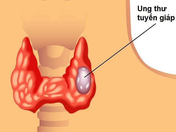 Ung thư tuyến giáp - Tỉ lệ chữa khỏi lên tới 100%