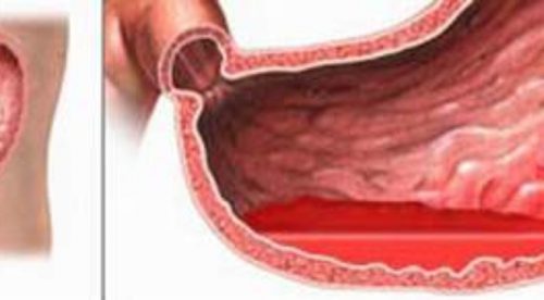 Xuất huyết tiêu hóa là bệnh lý đường tiêu hóa thường gặp.