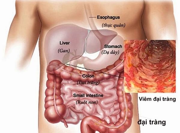 Các bệnh viêm đại tràng hoặc trực tràng cũng gây chảy máu trực tràng