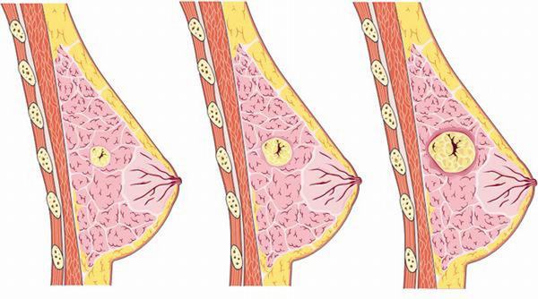U nang tuyến vú là một u lành tính thường gặp ở nữ giới trong độ tuổi 30-40.