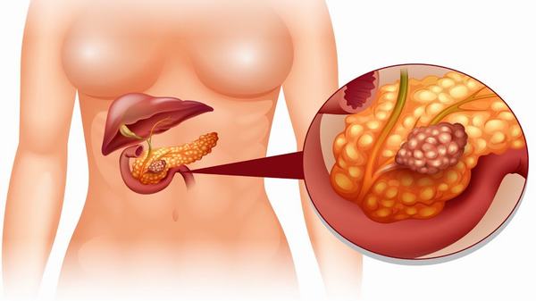Ở giai đoạn IV là giai đoạn tế bào ung thư phát triển to, xâm lấn sang các cơ quan lân cận