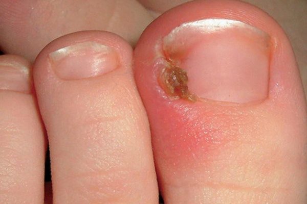 Lấy khóe móng chân bị chọc thịt phải làm gì?