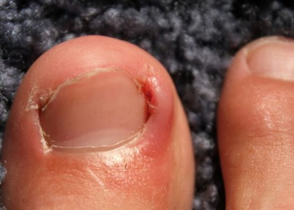 Lấy khóe móng chân có thể gây nên nhiều hậu quả khó lường