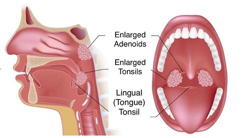 Phẫu thuật bằng dao plasma là kỹ thuật sử dụng đầu dò thông minh và kính soi điện tử, giúp tìm kiếm, tiêu diệt ổ bệnh.