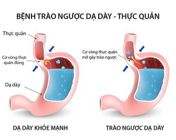 nguyen-nhan-va-trieu-chung-trao-nguoc-da-day-thuc-quan-2
