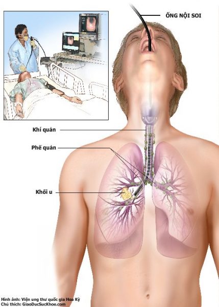 Ống nội soi dạng mềm đã khắc phục được hầu hết những hạn chế của loại ống cứng.