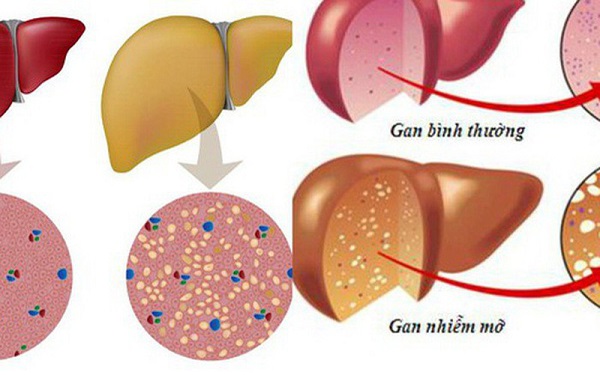 Gan nhiễm mỡ 